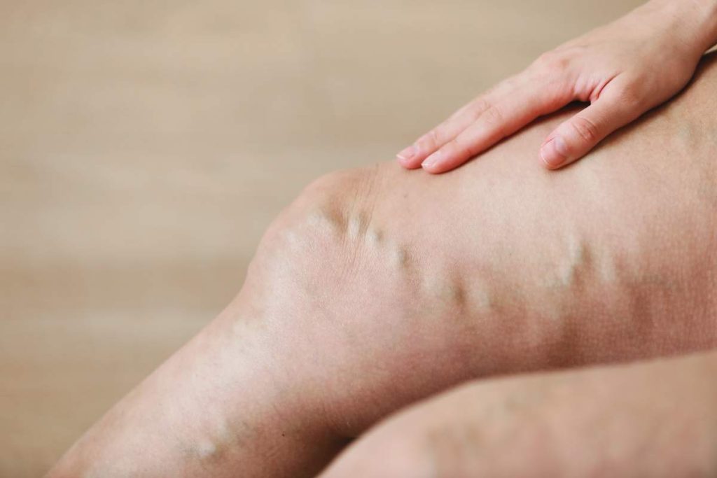 Varicose Veins: Causes and Treatment